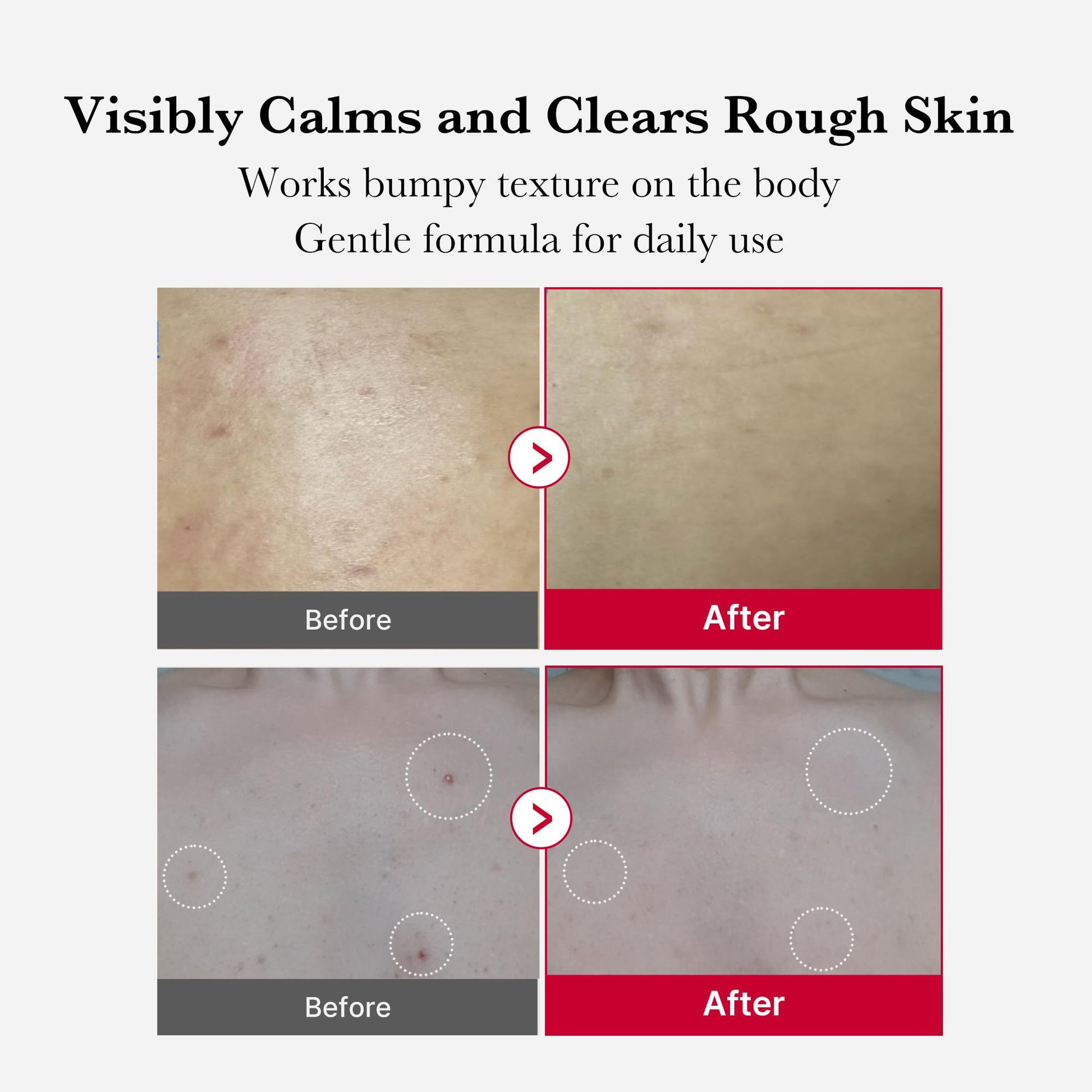 Medicube Red Acne Body Peeling Shot, AHA + BHA Exfoliating Body Spray 110g