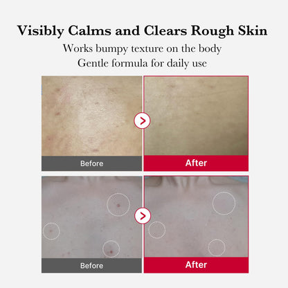 Medicube Red Acne Body Peeling Shot, AHA + BHA Exfoliating Body Spray 110g
