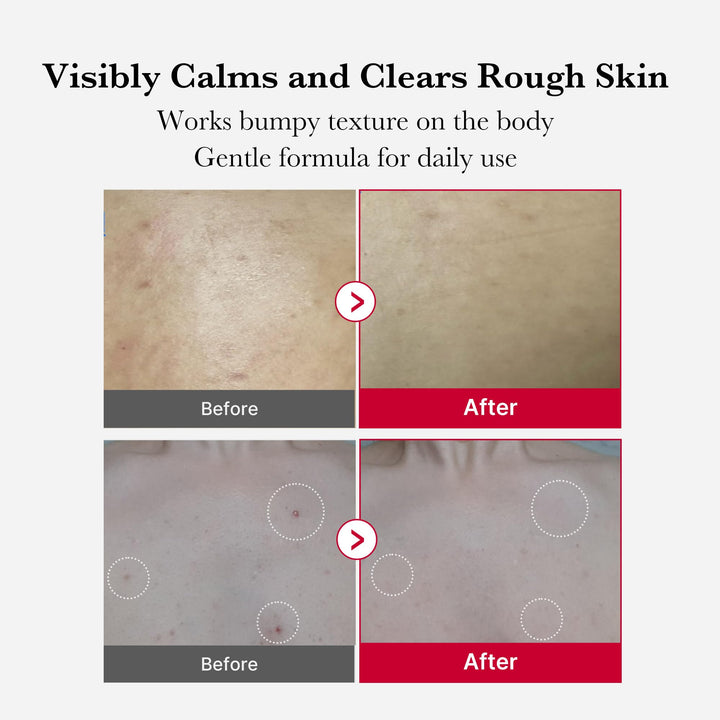 Medicube Red Acne Body Peeling Shot, AHA + BHA Exfoliating Body Spray 110g