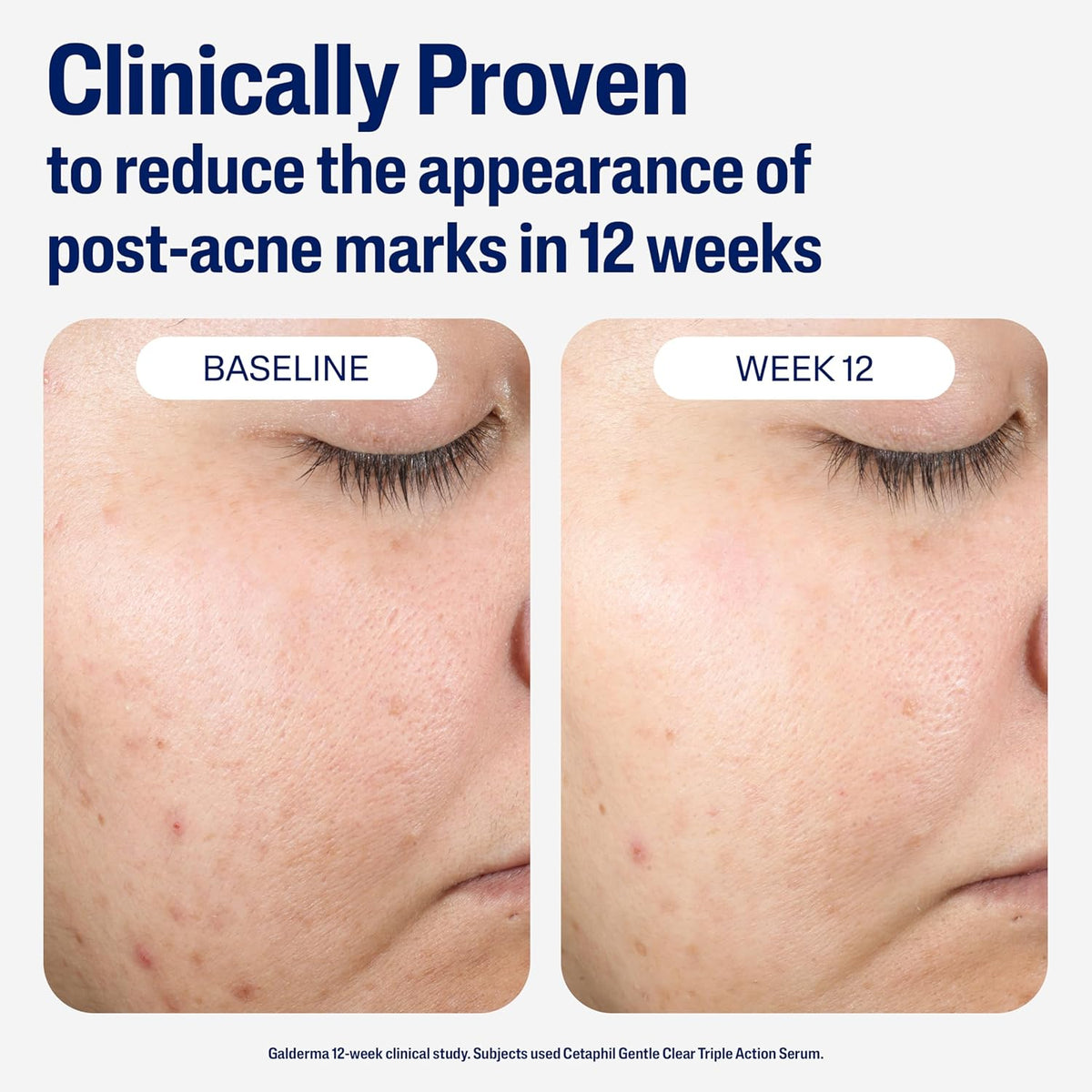 CETAPHIL Gentle Clear Repairing Post-Acne Serum, Retinol Alternative, Oil Free Serum 1 Fl Oz
