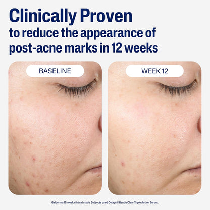 CETAPHIL Gentle Clear Repairing Post-Acne Serum, Retinol Alternative, Oil Free Serum 1 Fl Oz
