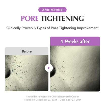 Before and after comparison of pore tightening treatment with EQQUALBERRY Purple PDRN Pore Minimizing Serum with Panthenol